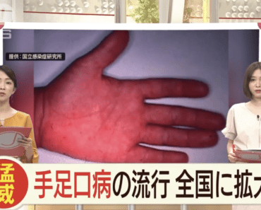 Bệnh chân tay miệng bùng phát ở Nhật, cách nhận biết và chăm sóc trẻ