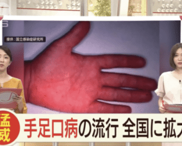 Bệnh chân tay miệng bùng phát ở Nhật, cách nhận biết và chăm sóc trẻ